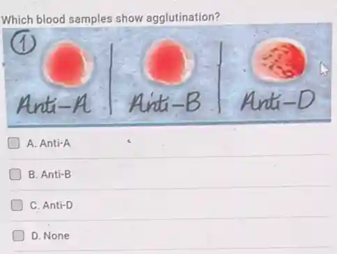 Which blood samples show agglutination?
A. Anti-A
B. Anti-B
C. Anti-D
D. None